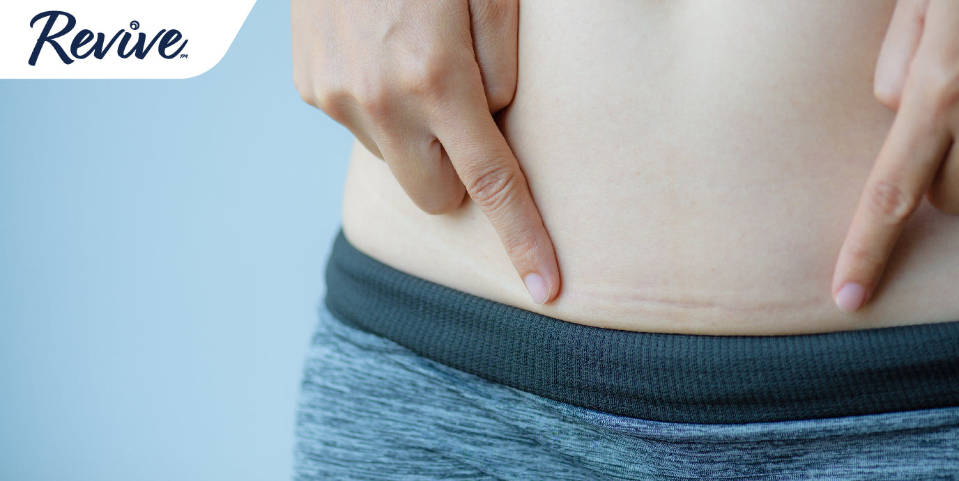 C-Sections and Light Bladder Leaks