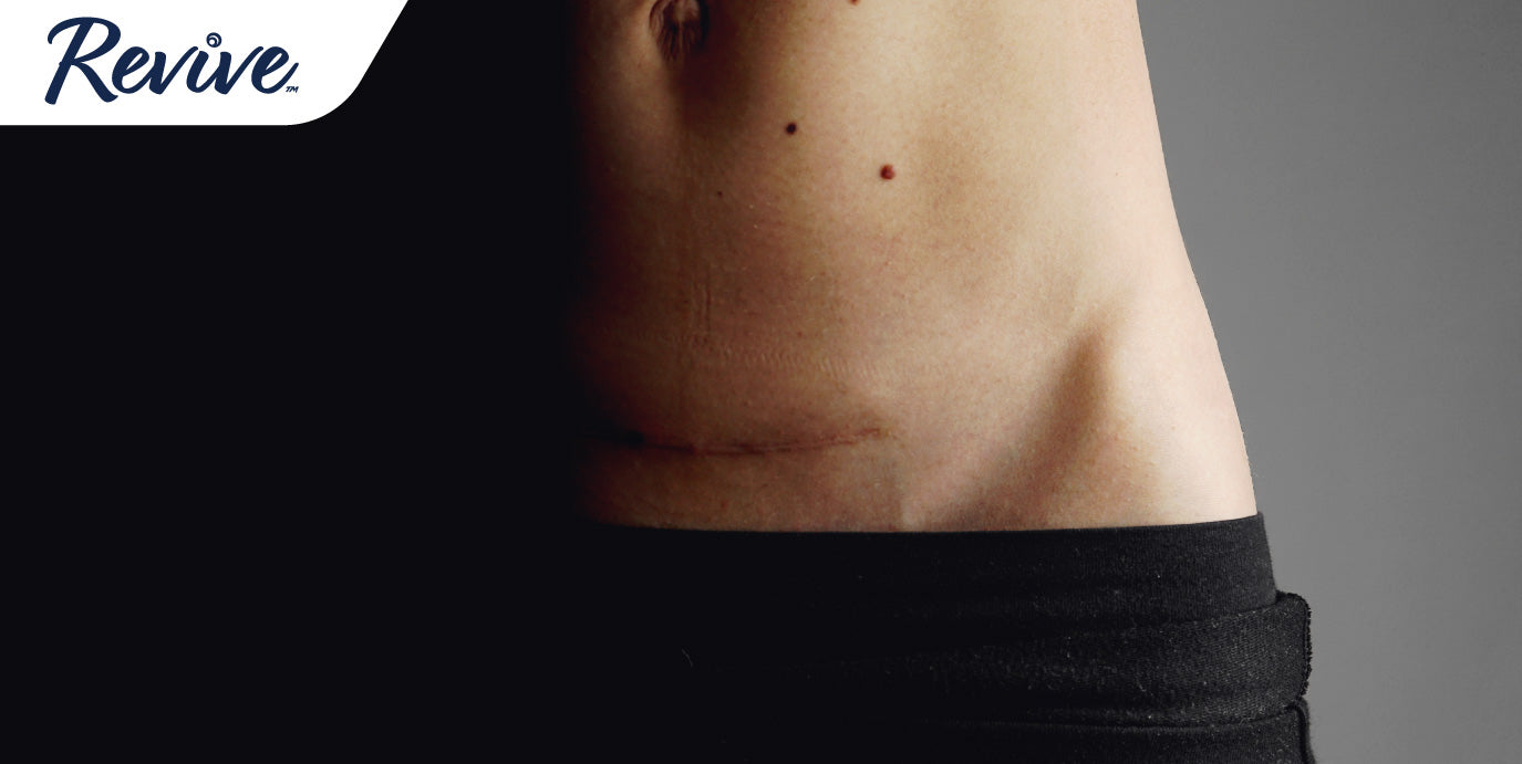 Bladder Leaks After Surgery: You're Not Alone