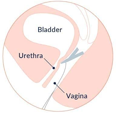 Revive Reusable Bladder Support (1 Month Supply)